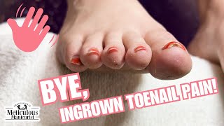 Ingrown Toenail Prevention at Home [upl. by Innaig]