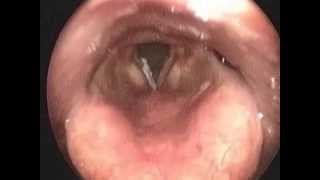 Larynx endoscopy vocal coed leukoplakia [upl. by Dazhahs]