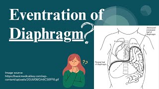 Eventration of Diaphragm Causes Symptoms and Treatment  Novice Medic [upl. by Ailic212]