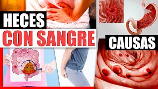 Sangre En Las Heces  Causas Y Tratamiento Natural Para Hemorroides Diverticulitis Ulceras Y Mas [upl. by Burn651]