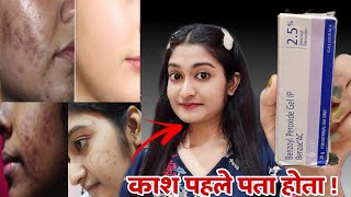 Benzoyl Peroxide Gel 25 review  Benzoyl peroxide gel 25  Benzoyl peroxide for acne [upl. by Bibah]