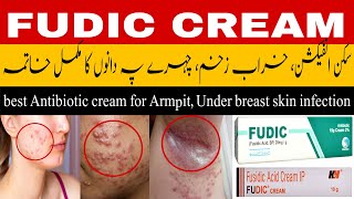 fudic cream uses  fusidic acid cream  antibacterial cream  best cream for acne  infected wound [upl. by Aerdnuahs]