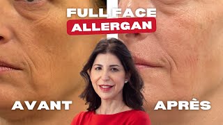 Full Face Allergan 💉✨ [upl. by Lezah]