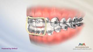 Orthodontic Treatment for Openbite  Rubber Bands [upl. by Dnomse677]