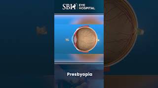 Presbyopia  What is presbyopia  SBH Hospital  Chhattisgarh [upl. by Pennebaker]