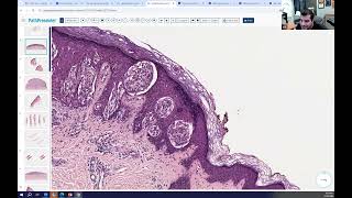 Avi Bitterman Dermpath Lecture 4 Melanocytic [upl. by Adrien962]