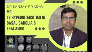 MRI T2 HYPERINTENSITIES IN BASAL GANGLIA AND THALAMUS  Dr Sanjay P Yadav  MRI Brain  Encephalitis [upl. by Yance]