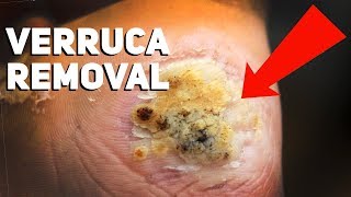 How to Get Rid of Plantar Warts at Home [upl. by Mendy]