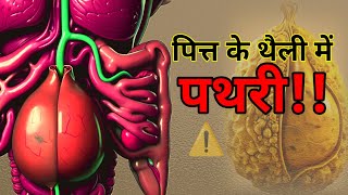 पित्त के थैली में पथरी के लक्षण और बचाव  Gallstone warning signs and solutions [upl. by Netsirhk]