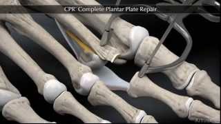 Plantar Plate Repair [upl. by Sy744]