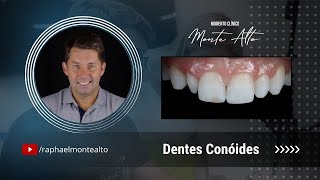 Dentes Conóides [upl. by Ansev574]