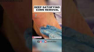 Deep satisfying corn removal  Miss Foot Fixer [upl. by Ardnuaet]