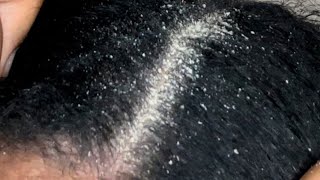 Dandruff Scratching Lots of Popping Flakes Off Dry Itchy Scalp [upl. by Kantos]