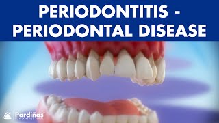 Gum disease  Periodontitis  Periodontal Disease © [upl. by Nawuq]