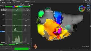 Left Atrial Flutter Case [upl. by Mcwherter]