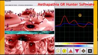 Atheromatous Aorta Medicomat Aorta Treatment [upl. by Ridley]