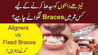 Fixed Braces VS Aligners In Urdu  Aligners For Teeth  Health And Nutrition [upl. by Ahsenre]