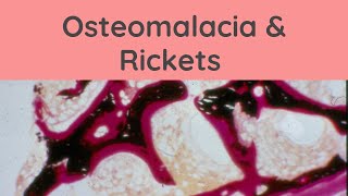 Osteomalacia and Rickets  Pathology mini tutorials [upl. by Nivra]