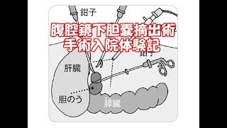 腹腔鏡下胆嚢摘出術 手術入院2日目 手術後 看護師さんとの会話 [upl. by Nilkoorb287]