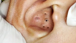 Big Cystic Acne Blackheads Extraction Blackheads amp Milia Whiteheads Removal Pimple Popping  8421 [upl. by Ardnohsed]