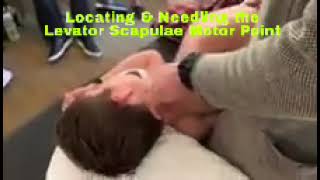 Locating amp Needling the Levator Scapulae Motor Point [upl. by Dollie885]