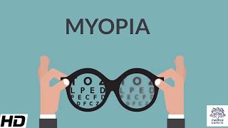 Myopia Signs and Symptoms Causes Diagnosis and Treatment [upl. by Tarra]