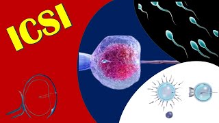 ICSI  Intracytoplasmic Sperm Injection [upl. by Capriola]