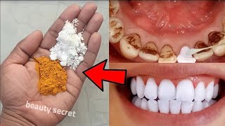 easy teeth whitening at home [upl. by Kcired]