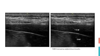 TAP Block Subcostal [upl. by Thalassa]