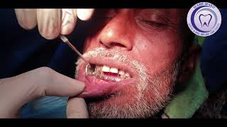 Fractured condyle of mandible  Dr Rajkumar R Choubey MDS  Dentist Ghazipur  Dentist Varanasi [upl. by Kathlin]