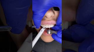 Cutting away temporary smile for final porcelain veneers 🦷 veneers dentalveneers porcelainveneer [upl. by Ogden]