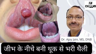 जीभ के नीचे बनी थूक से भरी थैली। Mucus retention cyst of tongue [upl. by Teak169]