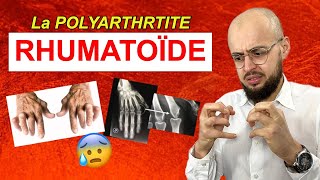 Les symptômes de la POLYARTHRITE RHUMATOÏDE [upl. by Claudy]