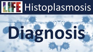 Histoplasmosis epidemiology amp diagnosis [upl. by Cianca]