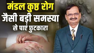 मंडल कुष्ठ रोग जैसी बड़ी समस्या से पाएं छुटकारा  Subhash Goyal  Psoriasis [upl. by Ynitsed]