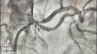 Renal Artery Angioplasty Ostial Bifurcation ISR [upl. by Oijile]