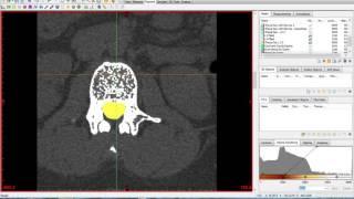 Materialise Mimics and 3Matic Tutorial [upl. by Aihsas]