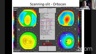 PG Orientation  Pachymetry  Dr Anil Radhakrishnan [upl. by Durkin]