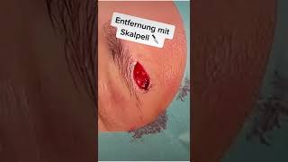 Muttermal im Gesicht entfernen – die OP 🔪 shorts plasticsurgery [upl. by Gathers]