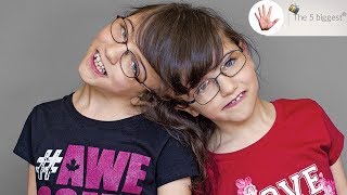 Do conjoined twins share thoughts Unbelievable facts  Body Bizarre [upl. by Spiegel315]