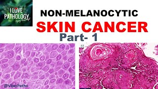 SKIN CANCER Non Melanocytic Part 1 Anatomy Etiopathogenesis amp Classification [upl. by Tips]