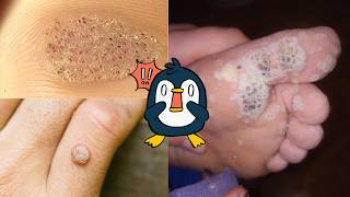 What causes warts and how to get rid of them [upl. by Onivag527]