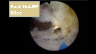 Holmium laser enucleation HoLEP Case 17 [upl. by Kwon]