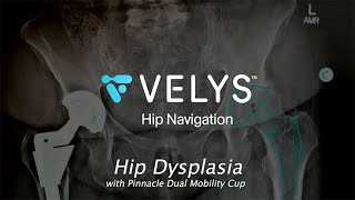 VELYS Hip Navigation with use of DEPUY PINNACLE DUAL MOBILITY LINER for Hip Dysplasia [upl. by Herrera]