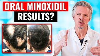 20000 PEOPLE TOOK ORAL MINOXIDIL AND THIS HAPPENED [upl. by Baniaz546]