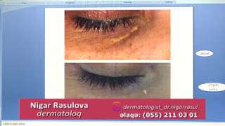 Dermatoloq DrNigar Rasulova KSANTELAZMANIN LAZERLE mualicesi [upl. by Alikee582]