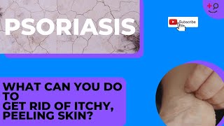 Psoriasis Treatments for You Get Rid of That Itchy Painful Rash [upl. by Ivar]