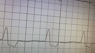 Electrocardiogram ECG or EKG 140 days after a leadless pacemaker implantation [upl. by Petes193]