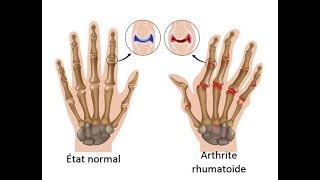 L’arthrite rhumatoïde  comment en contrôler les symptômes [upl. by Aratal]