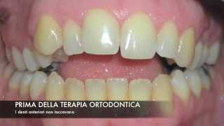 Incredibile Caso di Open Byte Prima e Dopo Studio Dentistico Cultrone [upl. by Vandervelde708]